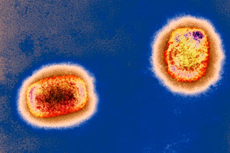 การเสียชีวิตจาก Monkeypox ครั้งแรกในสหรัฐฯ ได้รับการยืนยันในลอสแองเจลิส—โรคนี้ถึงขั้นเสียชีวิตได้